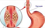 Đi khám viêm họng, bệnh nhân bất ngờ phát hiện mắc ung thư thực quản